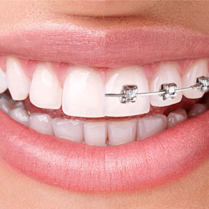 Braces-elaynery-3d-smile