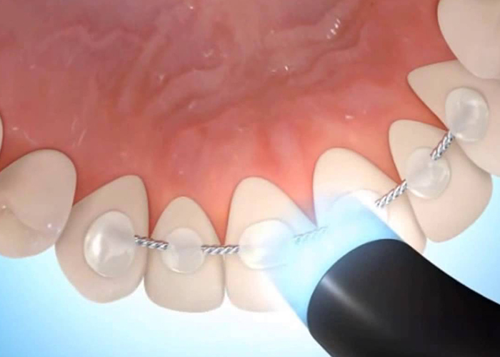 bracet-reteyner